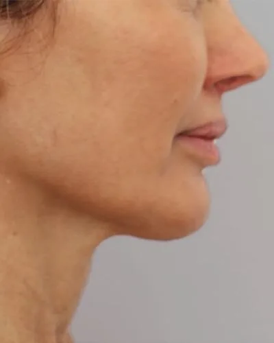 Profound RF skin tightening London - after photo of the jawline and neck in profile Jawline and neck in profile after Profound RF skin tightening at our London clinic
