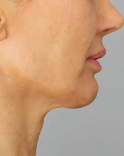 Profound RF skin tightening London - before photo of the jawline and neck in profile Jawline and neck in profile before Profound RF skin tightening at our London clinic